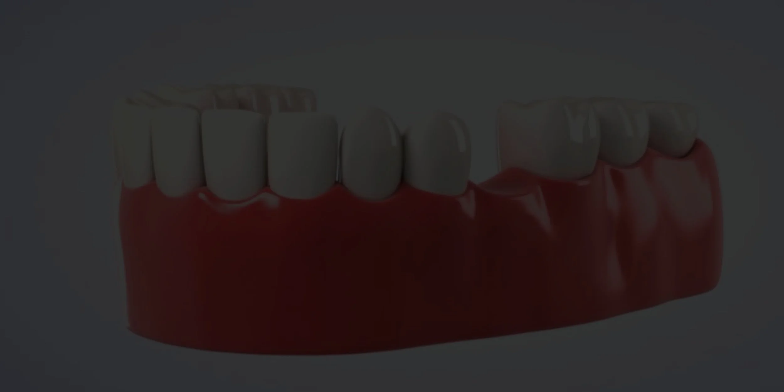 Dental Implants (1).jpg