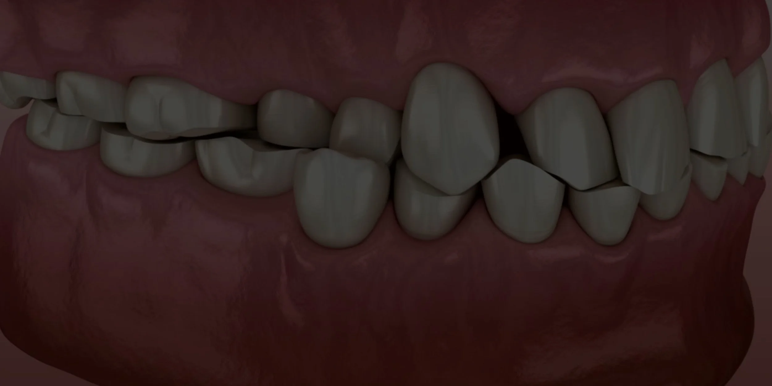 Worn Teeth.jpg