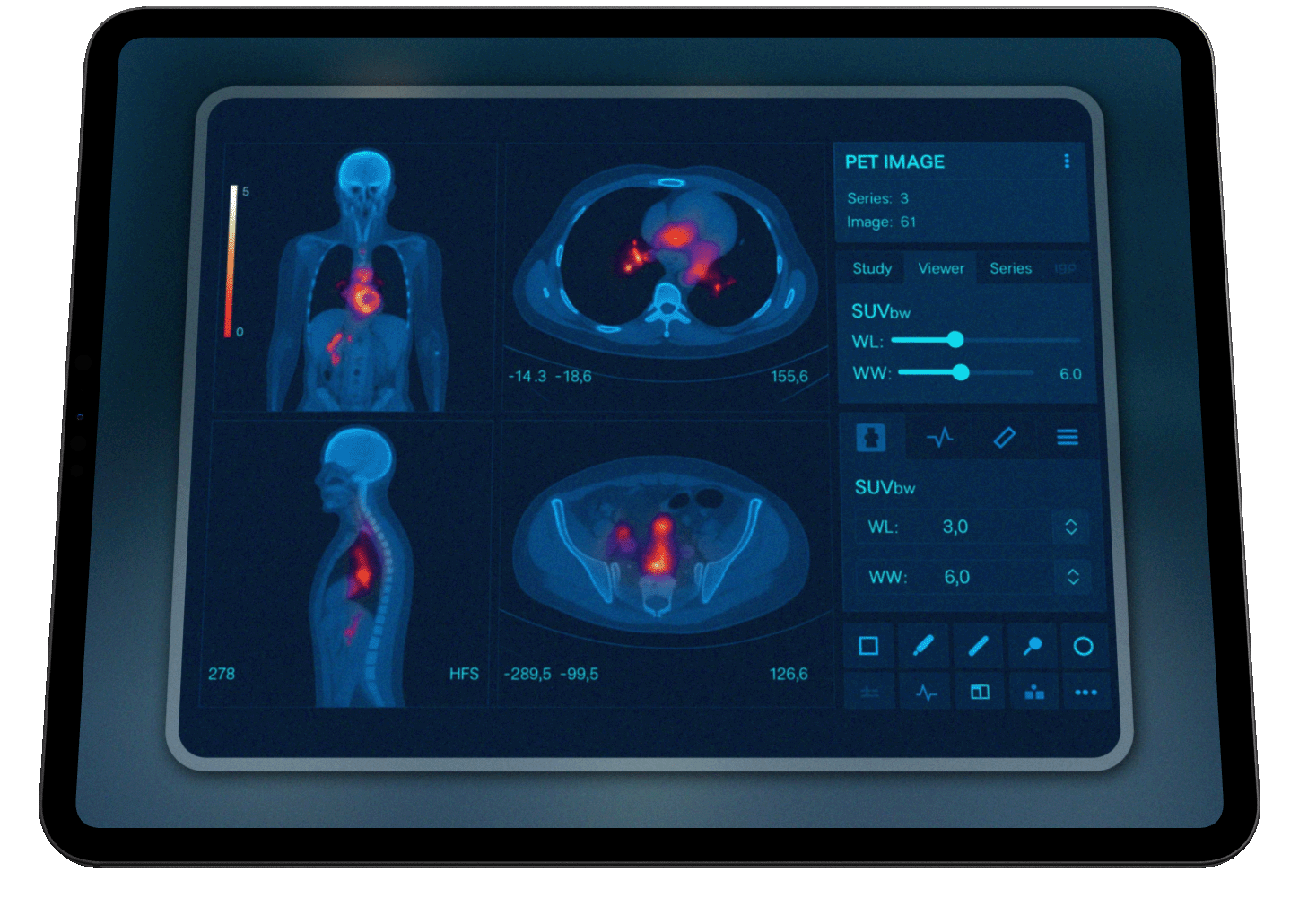 Nuclear Medicine PET scan displayed on a tablet screen, showing images of a human body from different angles, with increased uptake of radiotracer indicating areas of interest such as the chest and pelvic regions.
