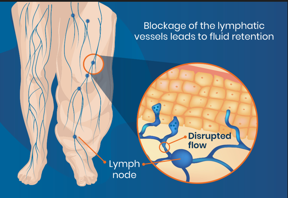 The Waters of the Body: Lymph Flow, Fascia, and the Slow Drain Pattern