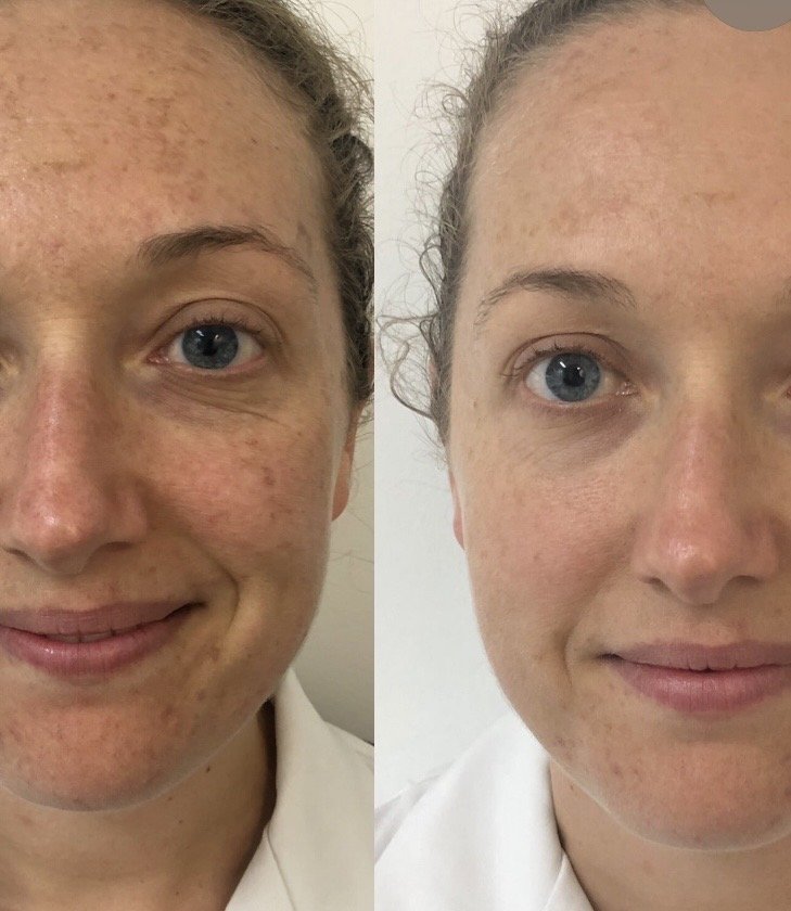 Before and After IPL treatment for facial pigmentation at Thanet Rejuvenation Studio in Ramsgate