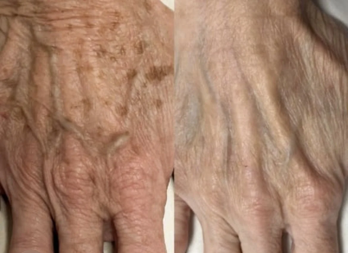 Before and After IPL treatment for pigmentation and age spots on the hand at Thanet Rejuvenation Studio in Ramsgate