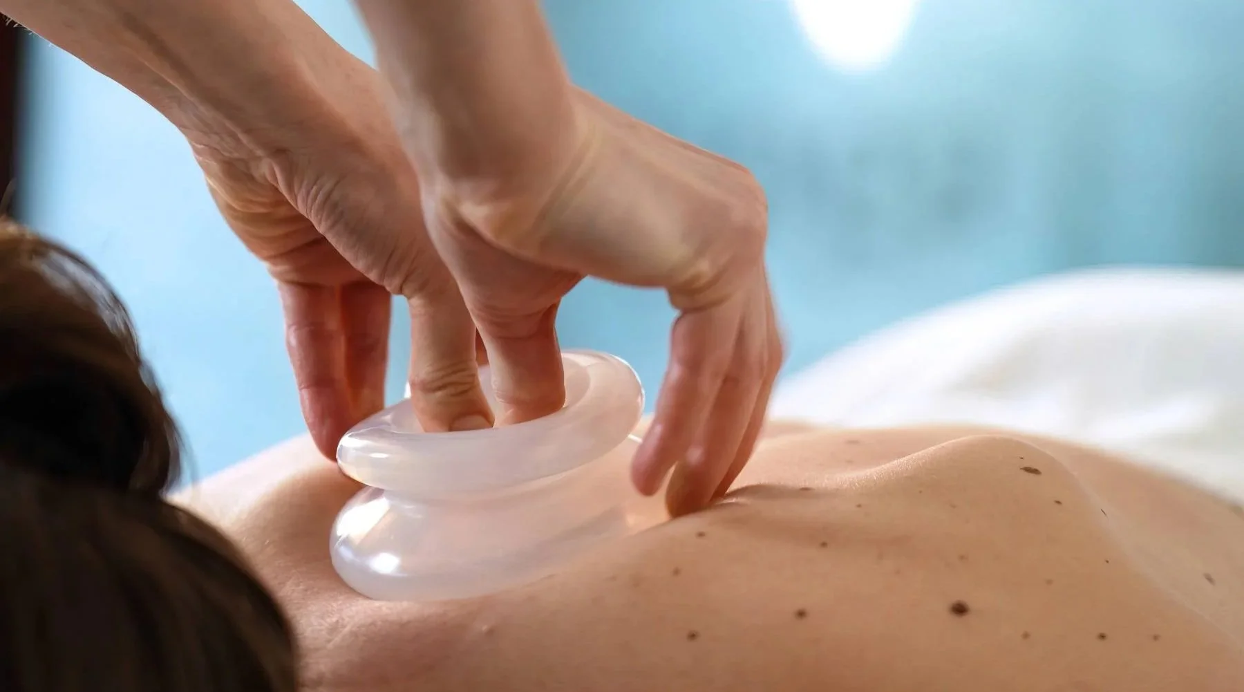 Close-up of a person receiving a cupping therapy session on their back by a healthcare professional.