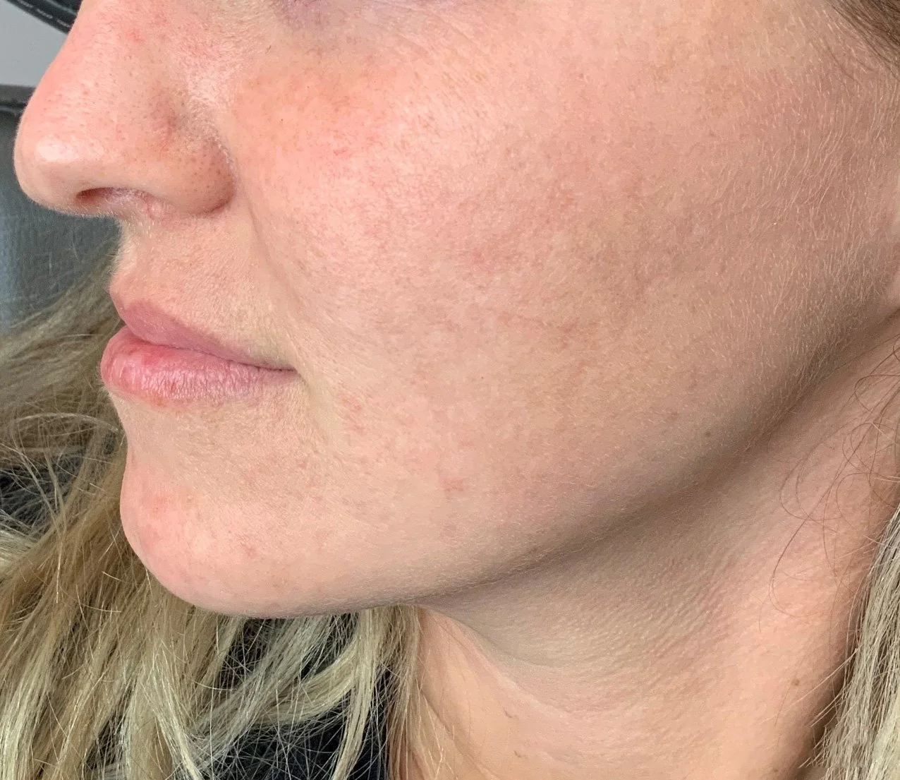 Close-up of a woman's cheek and lips, showing smooth skin with some redness and freckles.