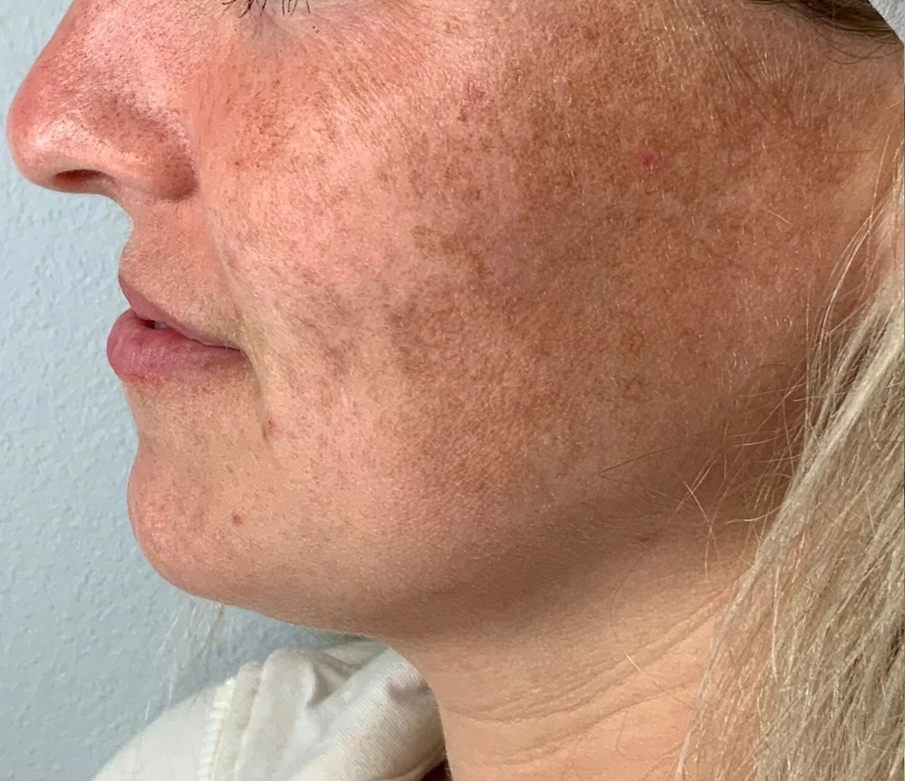 Close-up of a woman's face showing skin with mild redness and some small blemishes on the cheek and chin.