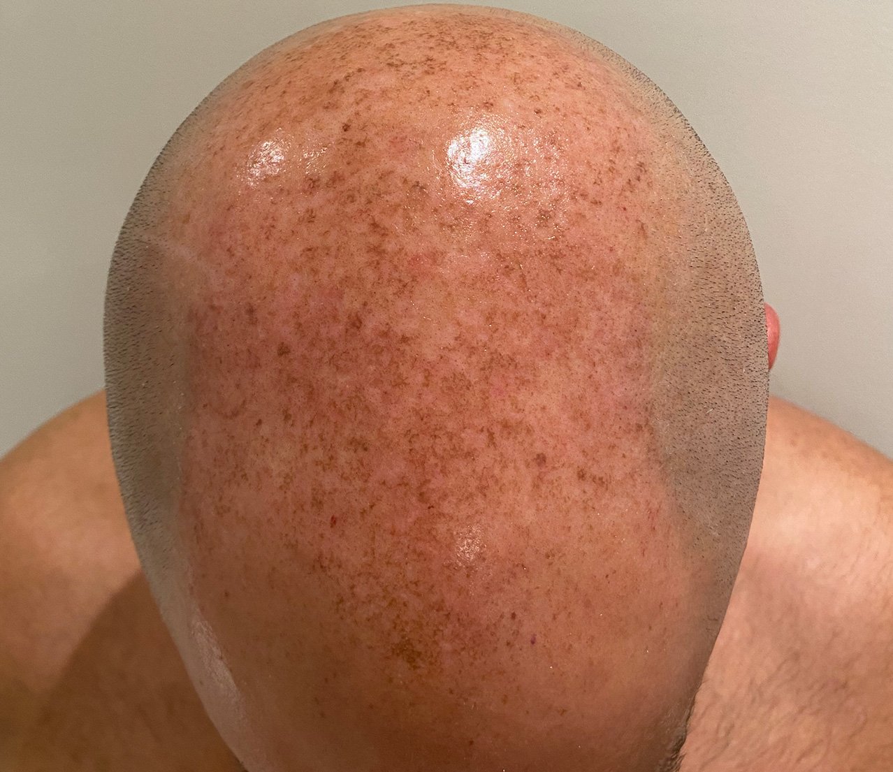 Close-up of a person's bald scalp with reddish-brown freckles and smooth skin.
