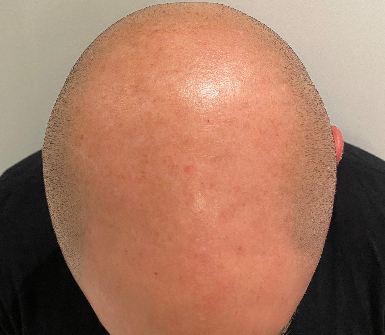Top view of a person's shaved head with visible skin texture and small red blemishes.