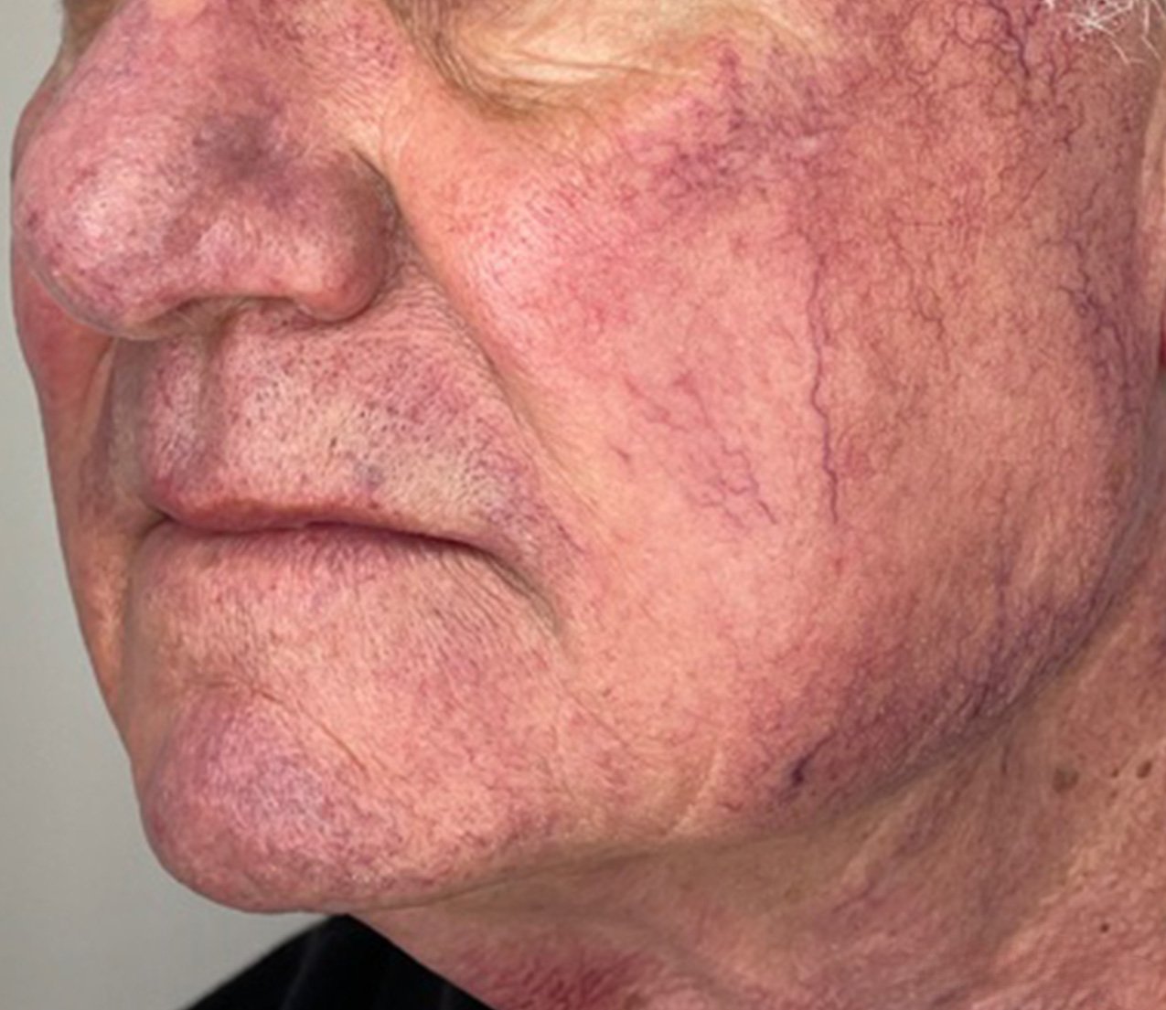 Close-up of an elderly person's face showing visible redness, broken blood vessels, and skin texture changes.