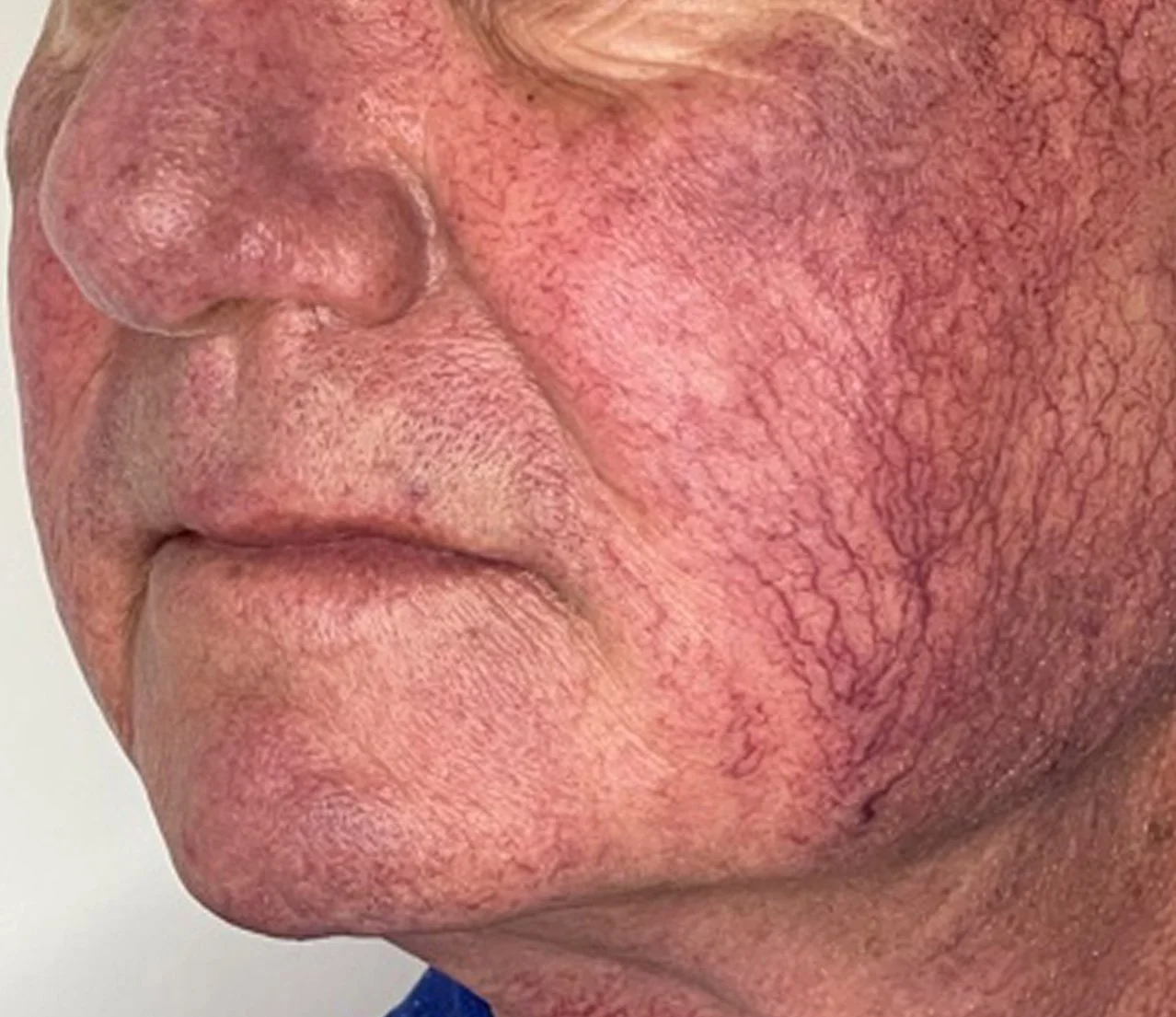 Close-up of an elderly person's face showing redness, visible blood vessels, and skin texture on the cheek.