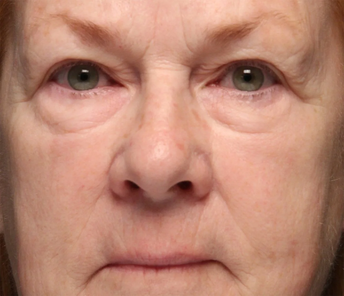Before- Older woman with loose and wrinkly skin around eyes and mouth