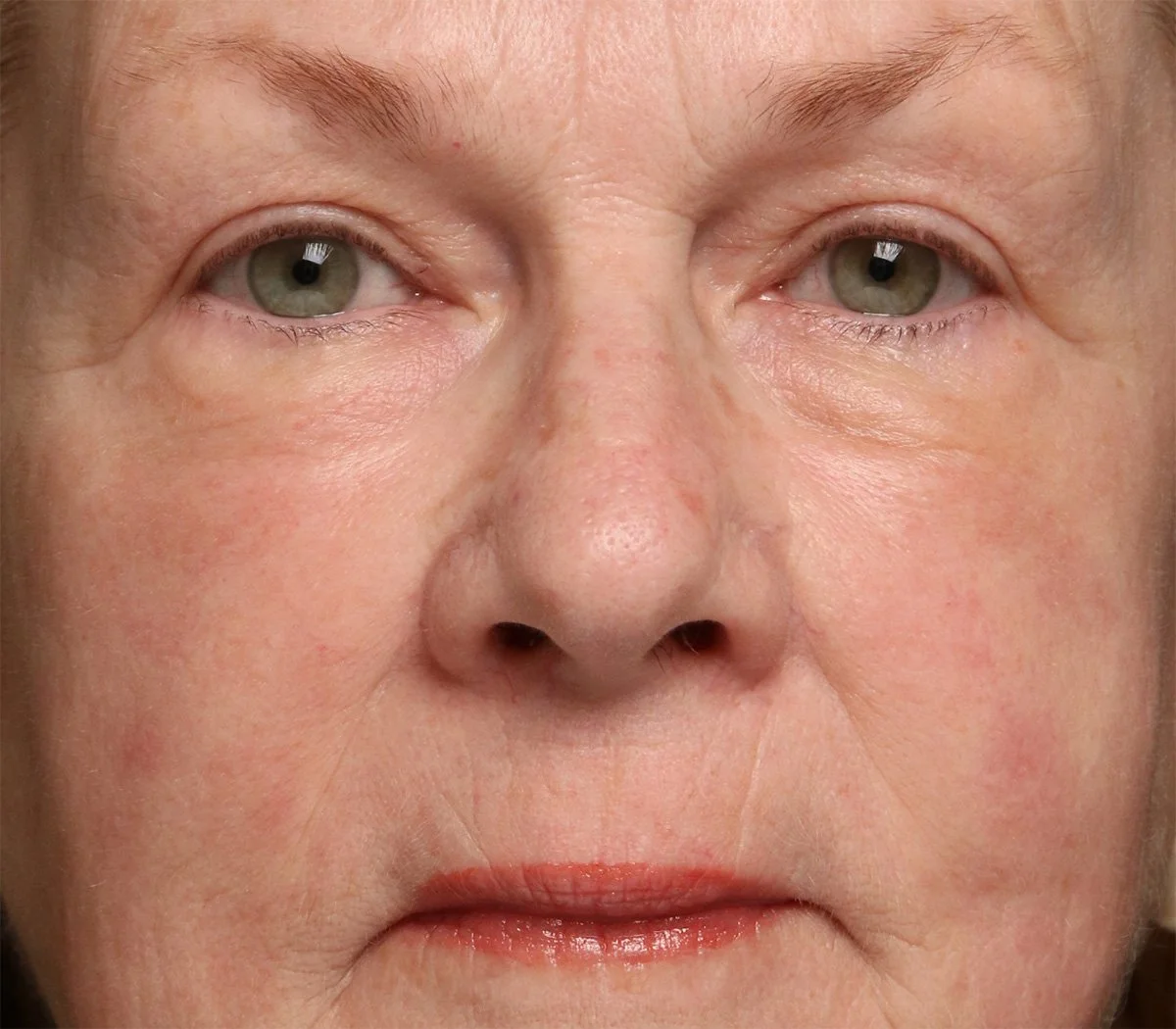 After- Older woman with tighter skin around eyes and mouth