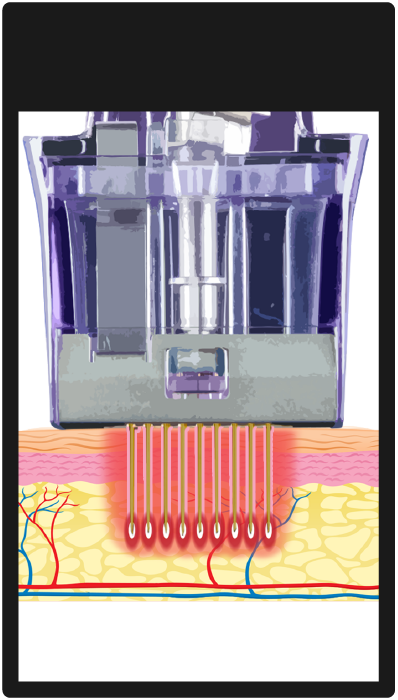 Cross-section illustration of a laser hair removal device targeting hair follicle and skin layers.