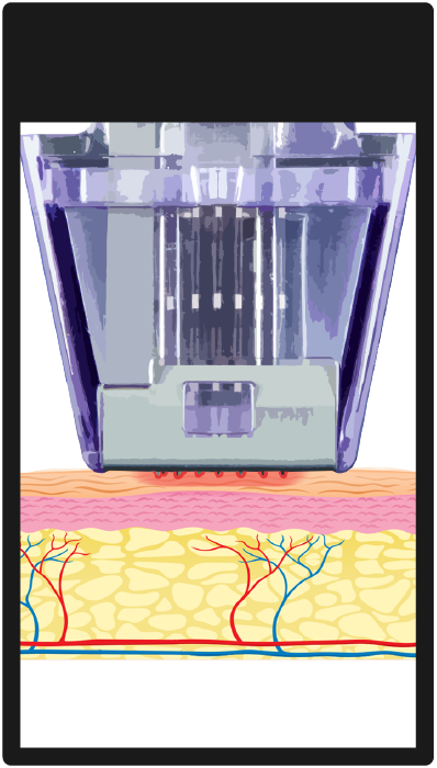 Illustration of a tattoo machine tattooing a design on skin layered over tissue and blood vessels.