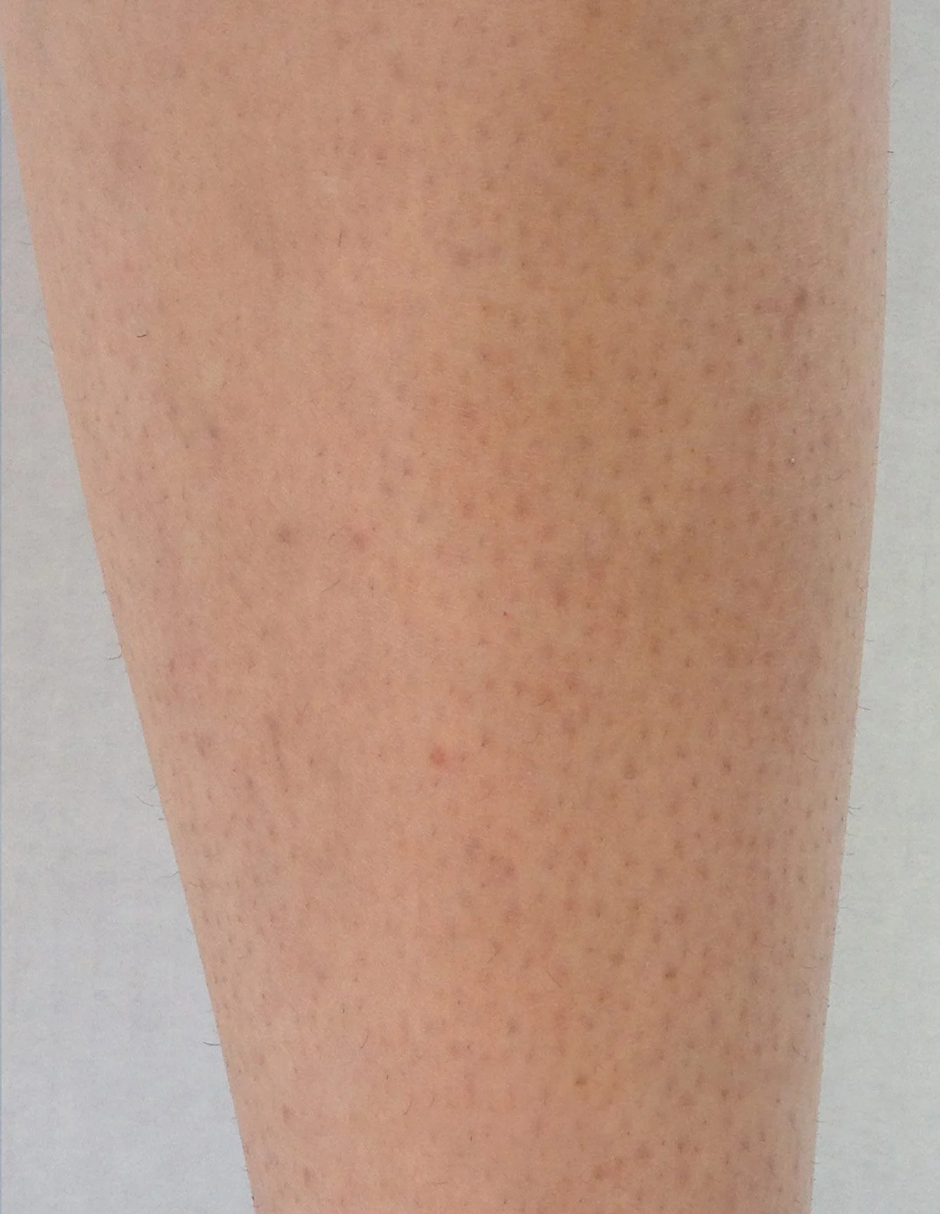 Close-up of a person's arm with freckles and fair skin.