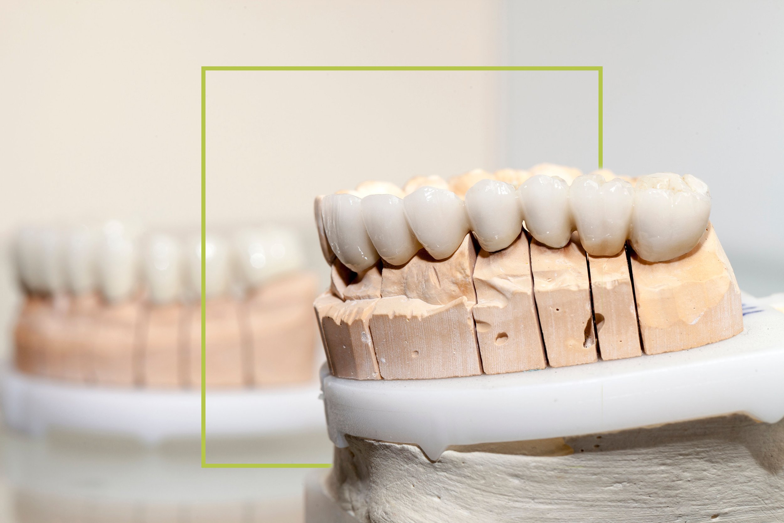 Dental prosthetic teeth on a dental model, close-up view.