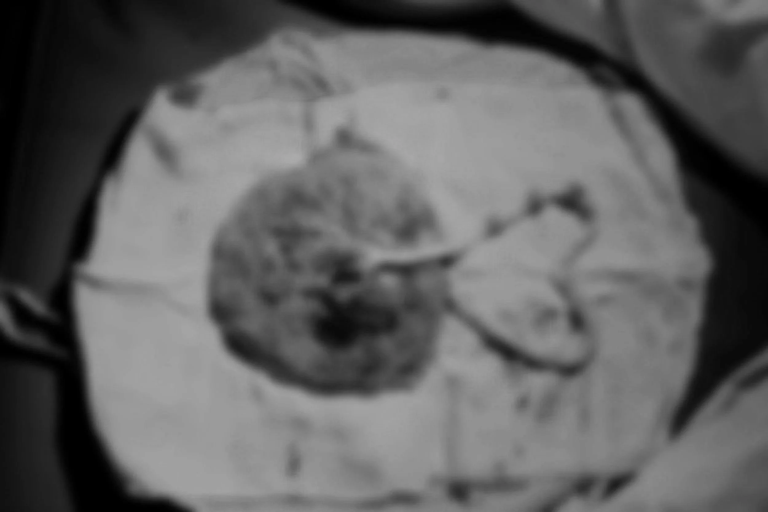 A black and white placenta shown after birth