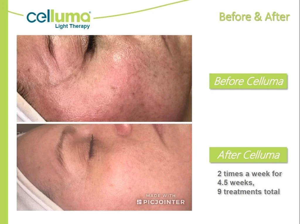 A before and after comparison photo of a person's skin, showing improved skin texture and reduced redness after Celluma light therapy. The before photo shows acne and skin imperfections, while the after photo shows clearer skin with fewer imperfections. The text indicates 2 treatments per week for 4.5 weeks, totaling 9 treatments.