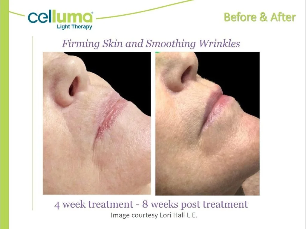 Side-by-side comparison of a person's lower face and lips before and after 4 weeks of Celluma light therapy treatment, showing reduced wrinkles and firmer skin.