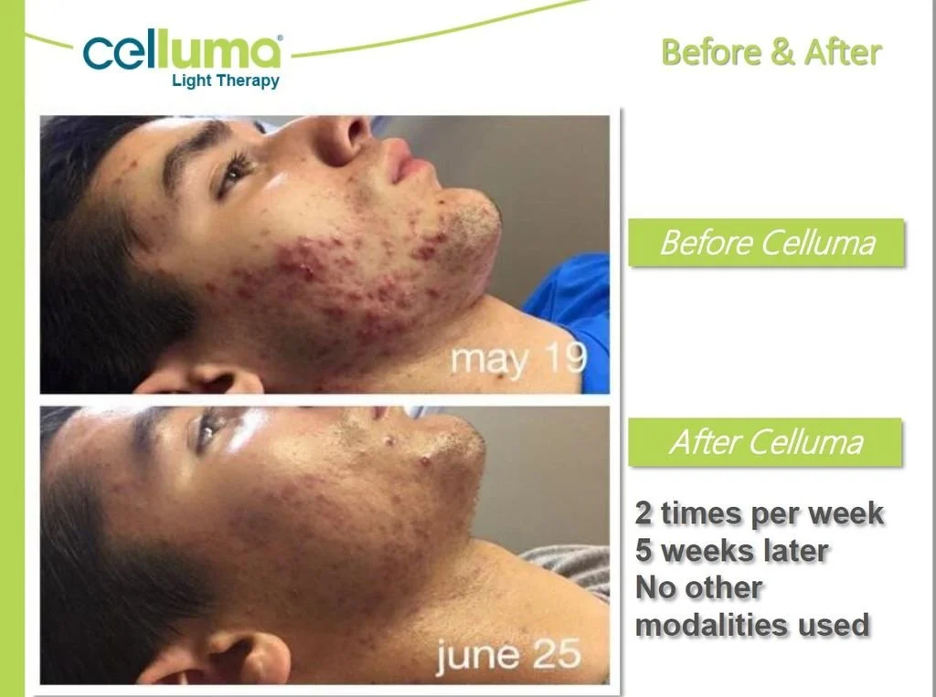 Before and after photos showing a person with severe acne on May 19 and June 25, demonstrating skin improvement after Celluma Light Therapy, which was performed twice weekly for five weeks without other treatments.