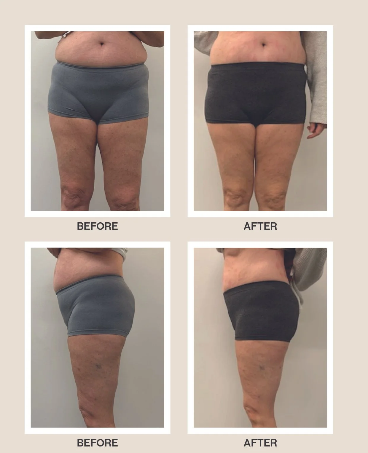 Comparison of a woman's thighs and hips in before and after photos, showing visible reduction in size and skin texture improvements.