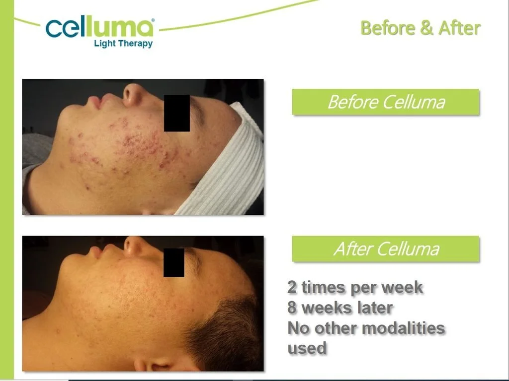 Comparison of a person's face before and after Celluma light therapy, showing significant improvement in skin condition after eight weeks of treatment with no other modalities used.