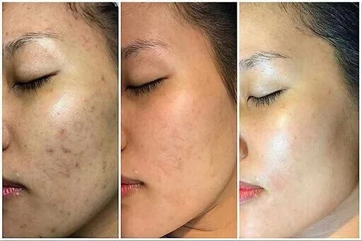 microneedling.jpg