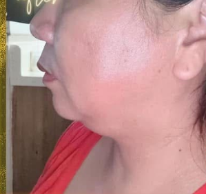 Close-up profile of a woman's face and neck, showing skin texture and slight redness.