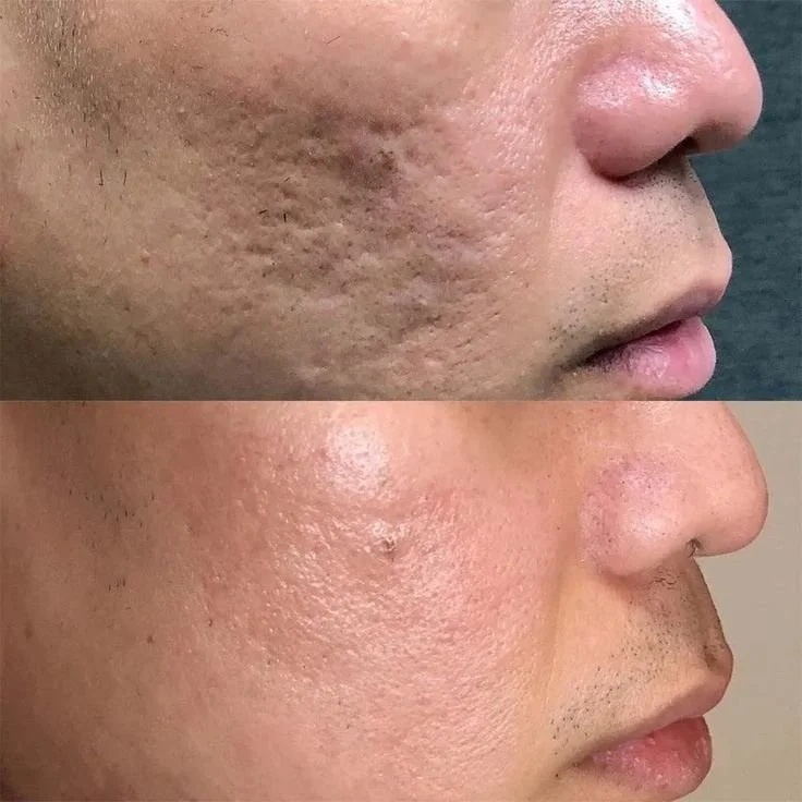 microneedling.jpg