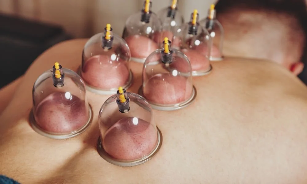 What Is Myofascial Cupping And How Does It Work?