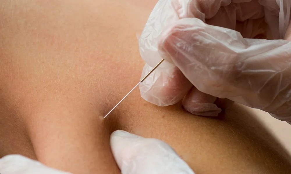 What Is Dry Needling Used For In Muscle Recovery And Pain Management?