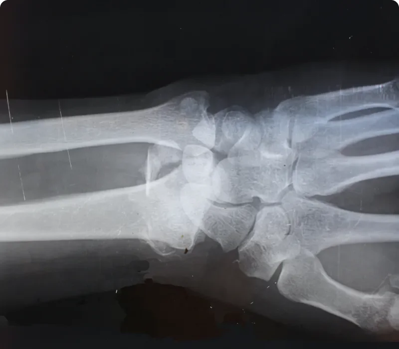 X-ray image of a human wrist showing bones and joints.