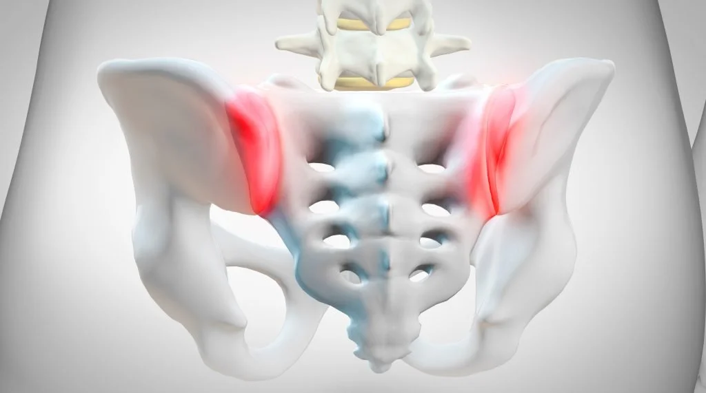 The Silent Epidemic: Understanding and Treating Sacroiliac Joint (SIJ) Dysfunction