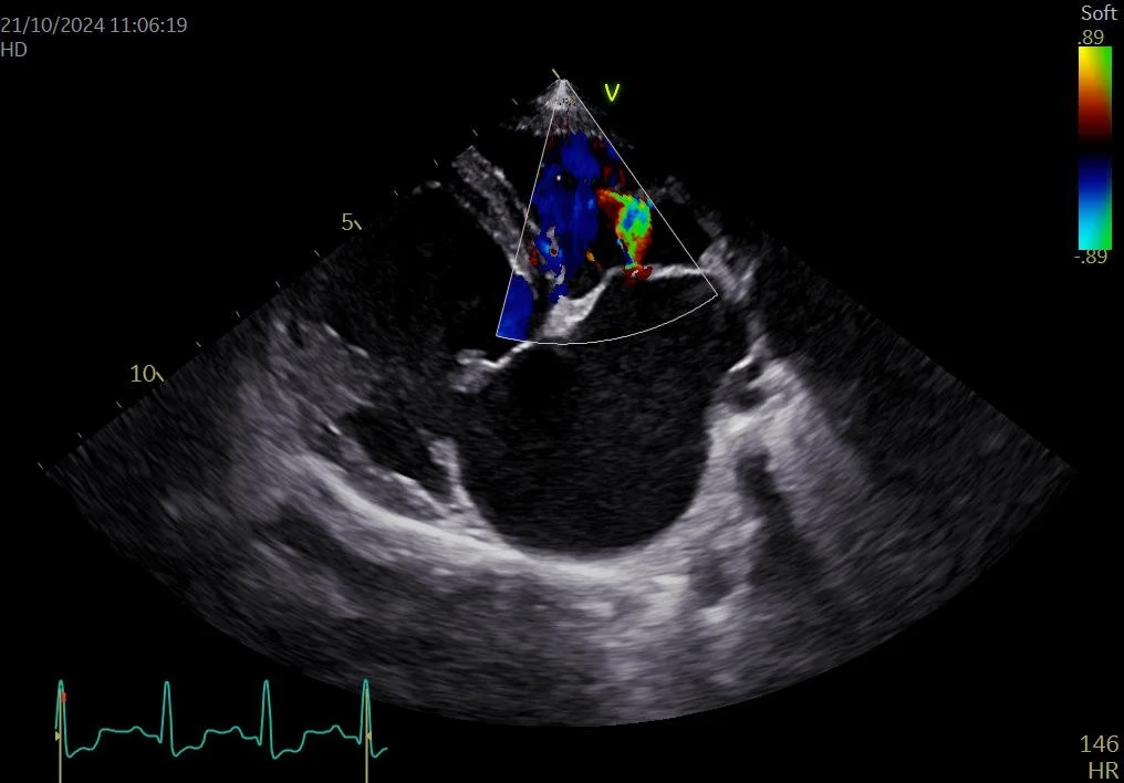 Echo acquired interatrial septal defect in dog with myxomatous mitral valve disease