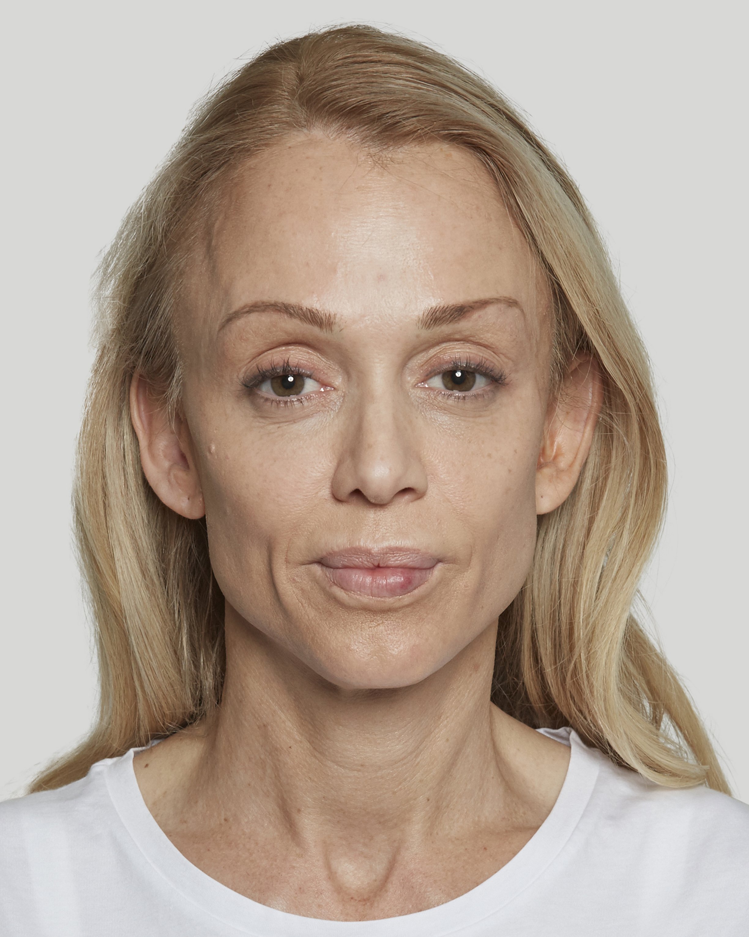 Anna after Sculptra 1 front2.jpg