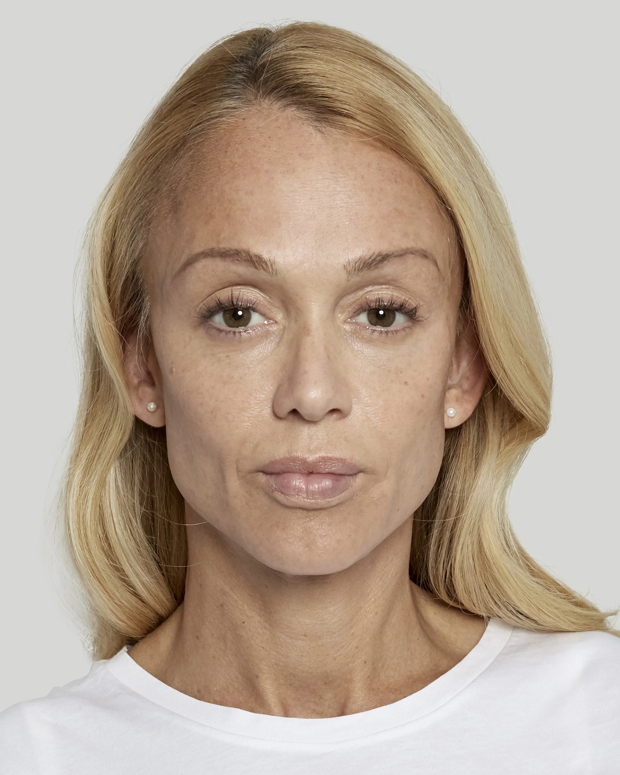 Anna after Sculptra 2 front2.jpg