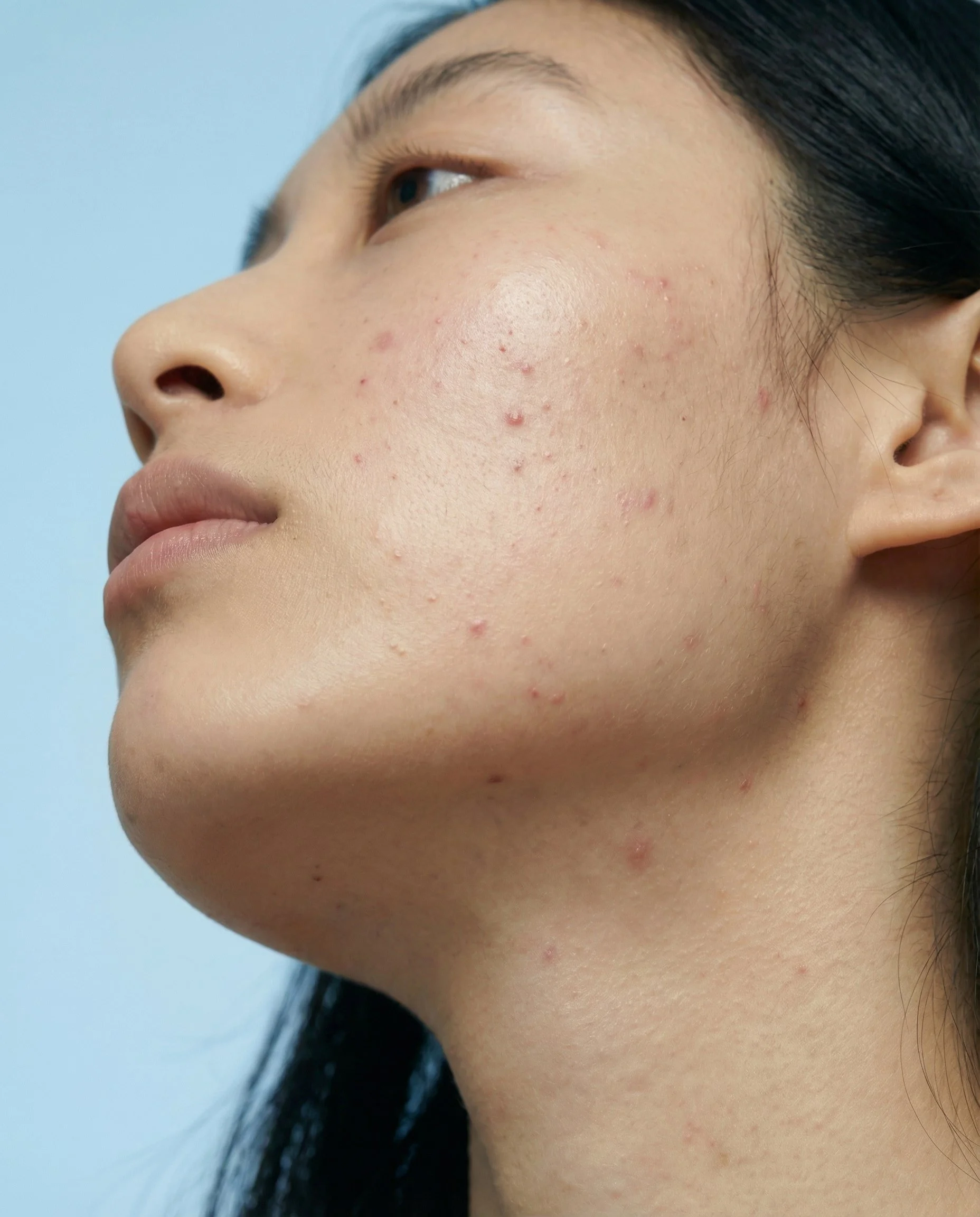 Vue rapprochée du visage d'une femme avec acné sur la joue et le menton.