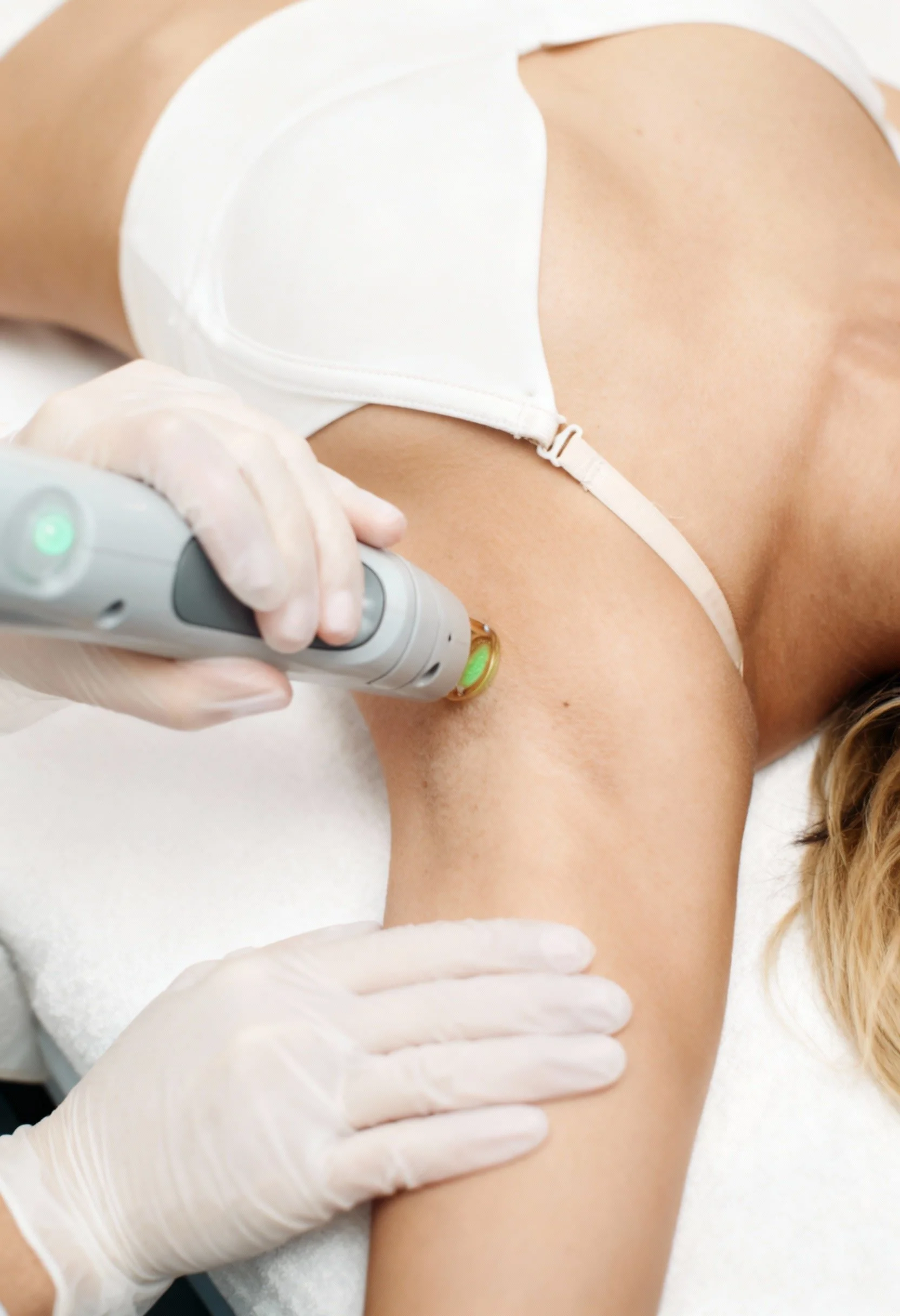 Zone des aisselles traitée en épilation laser médicale pour une peau plus lisse et durablement sans poils.