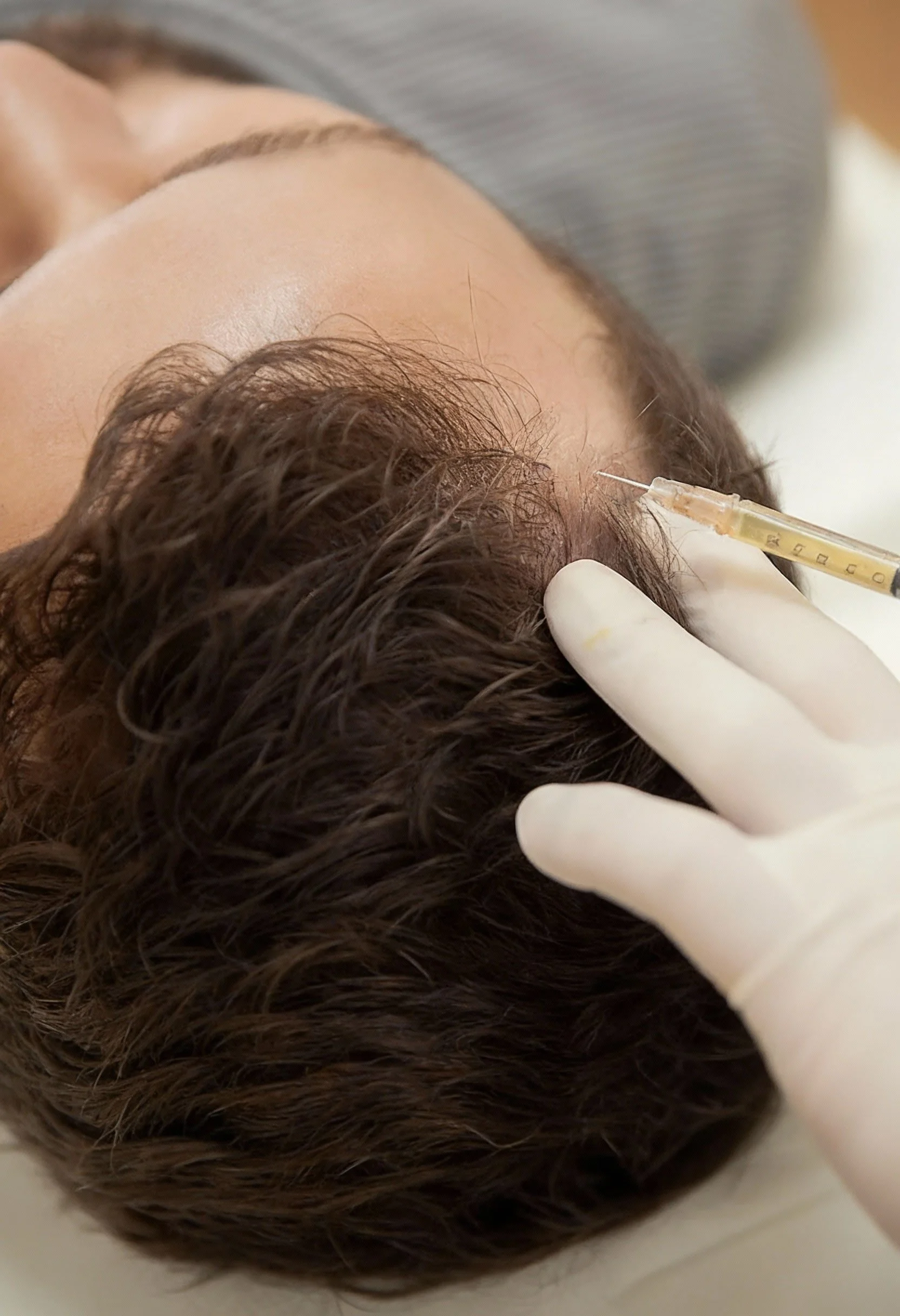 Résultats du traitement par facteurs de croissance pour la densité capillaire – médecine esthétique Dr Samson