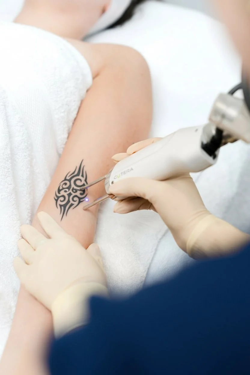 Séance de détatouage laser Cutera Enlighten sur un bras avec tatouage noir, réalisée en cabinet médical.
