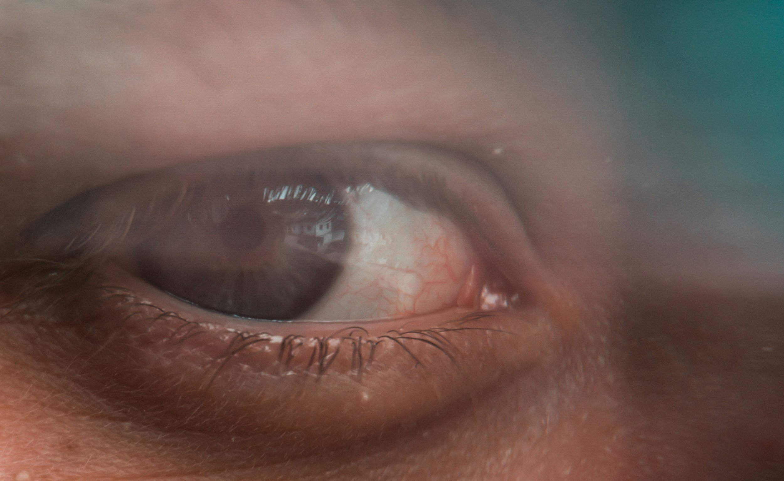 Glaucoma