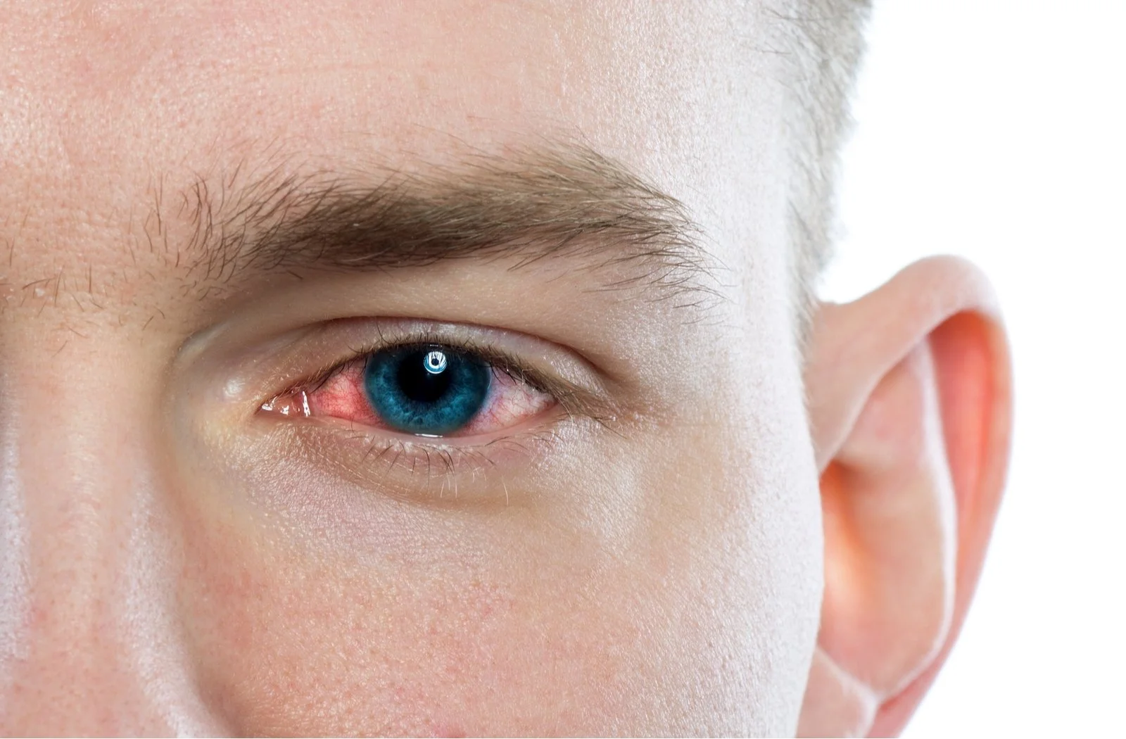 Conjunctivitis (“Pink Eye”)