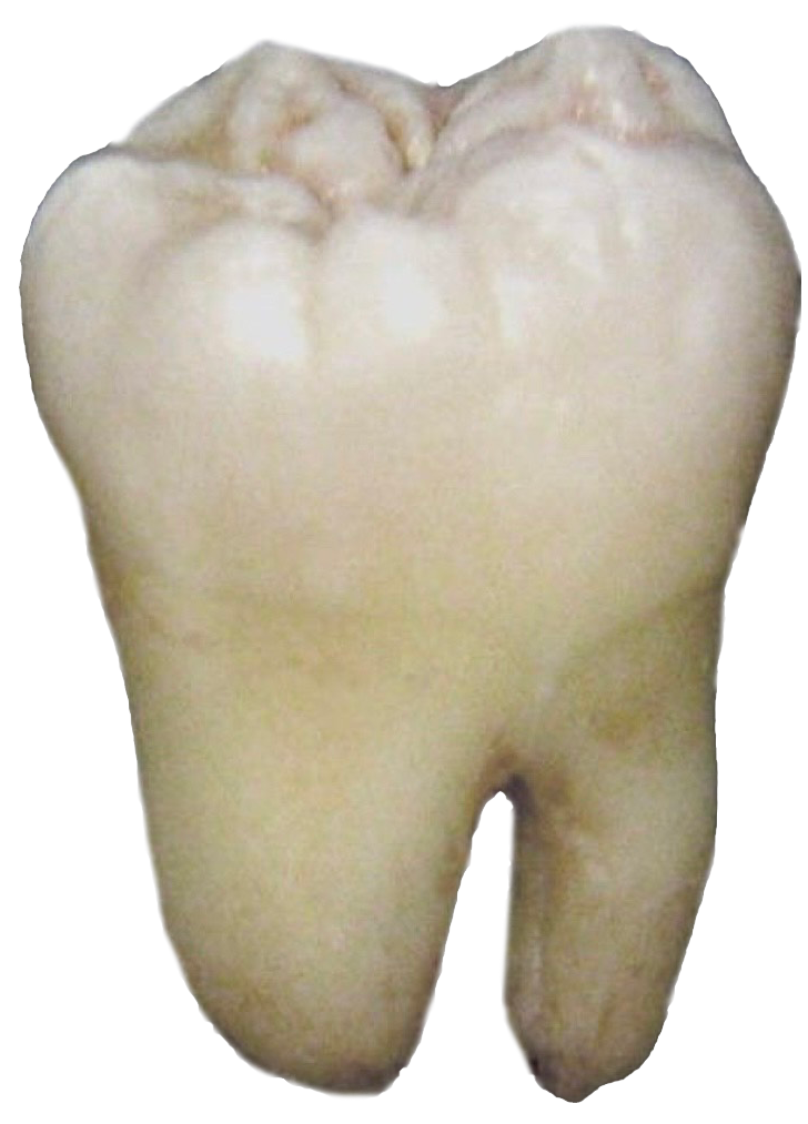 A close-up of a human molar tooth with visible cusps and a yellowish-white color.
