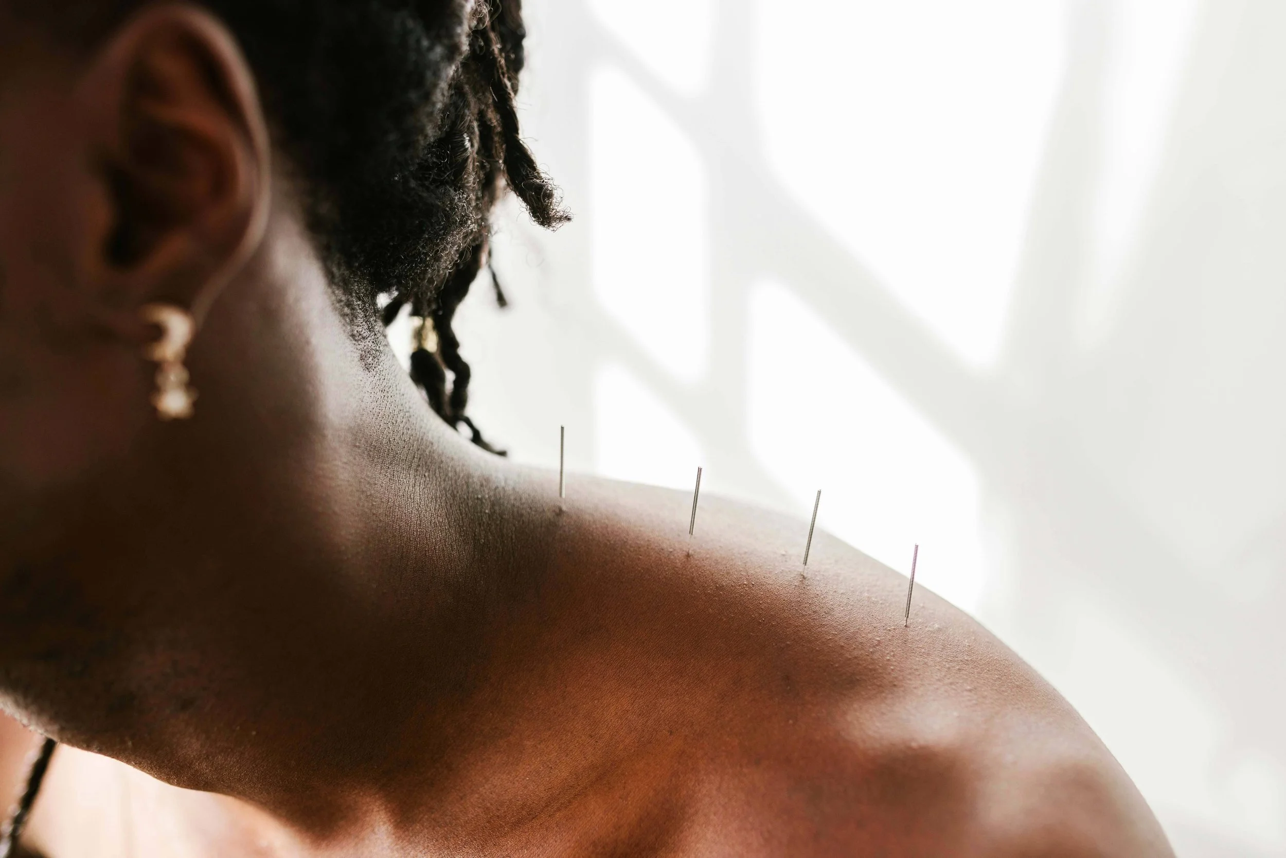 Acupuncture needles in woman's shoulders
