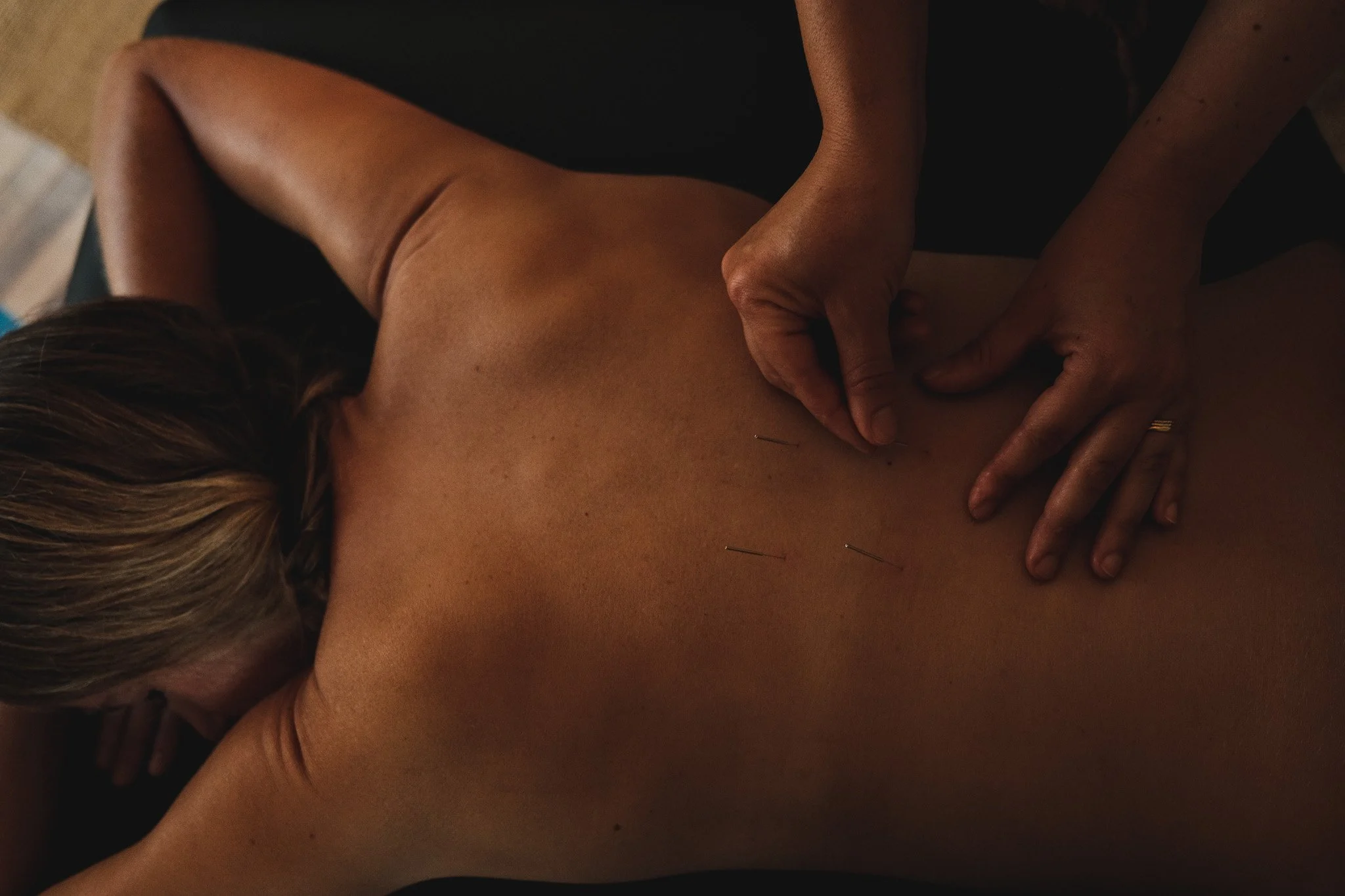 A person receiving acupuncture treatment on their back with several acupuncture needles inserted.