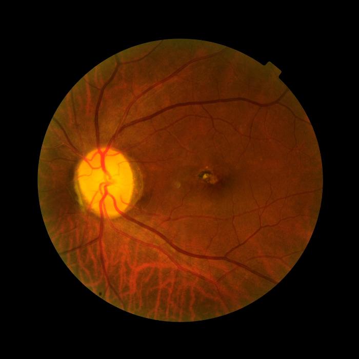 Retinal image showing the optic disc, blood vessels, and macula in the human eye.