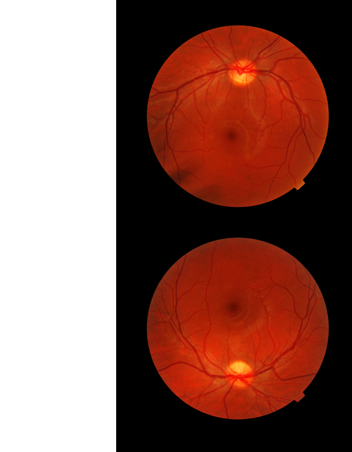 Two retinal fundus images showing the optic disc, blood vessels, and macula with no noticeable abnormalities.