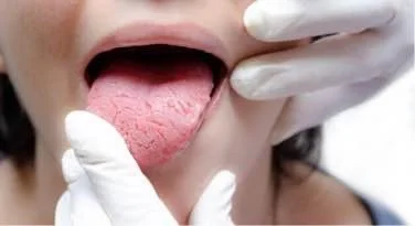 🦷 Menopausa e salute orale: perché aumenta il rischio di carie.