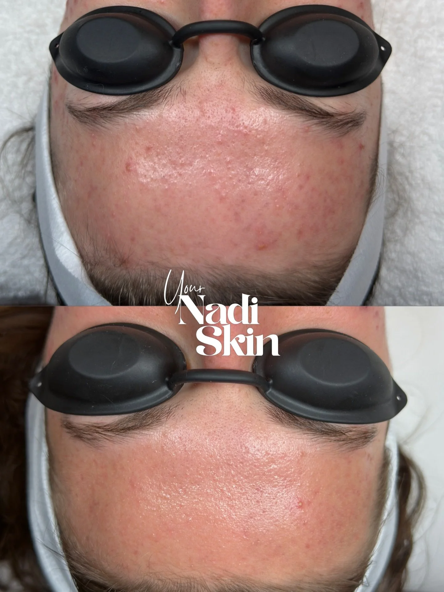 Loving these results for my client! She is so consistent, even went on vacation and did not miss a beat in her routine and does not play about sunscreen🥹🫶🏾 2 weeks in!
Using @facerealityskincare products!
&bull;
#acne #acnespecialist #nashvilleacn