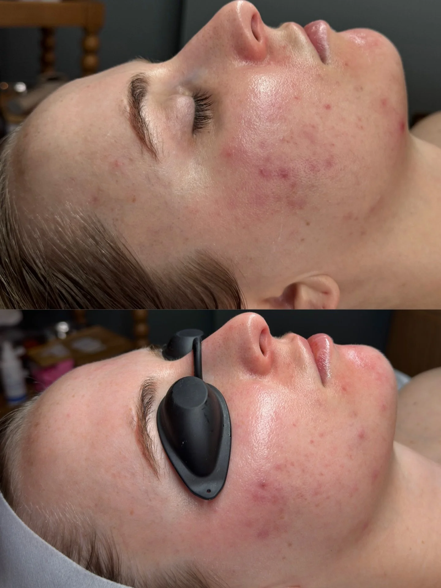 2 weeks⌛️Not acne treatment but barrier repair.

2 weeks ago when she came in, her skin barrier was compromised &mdash; inflamed, reactive, and overloaded with actives. We simplified her routine. Focused on calming &amp; healing.

This is what happen