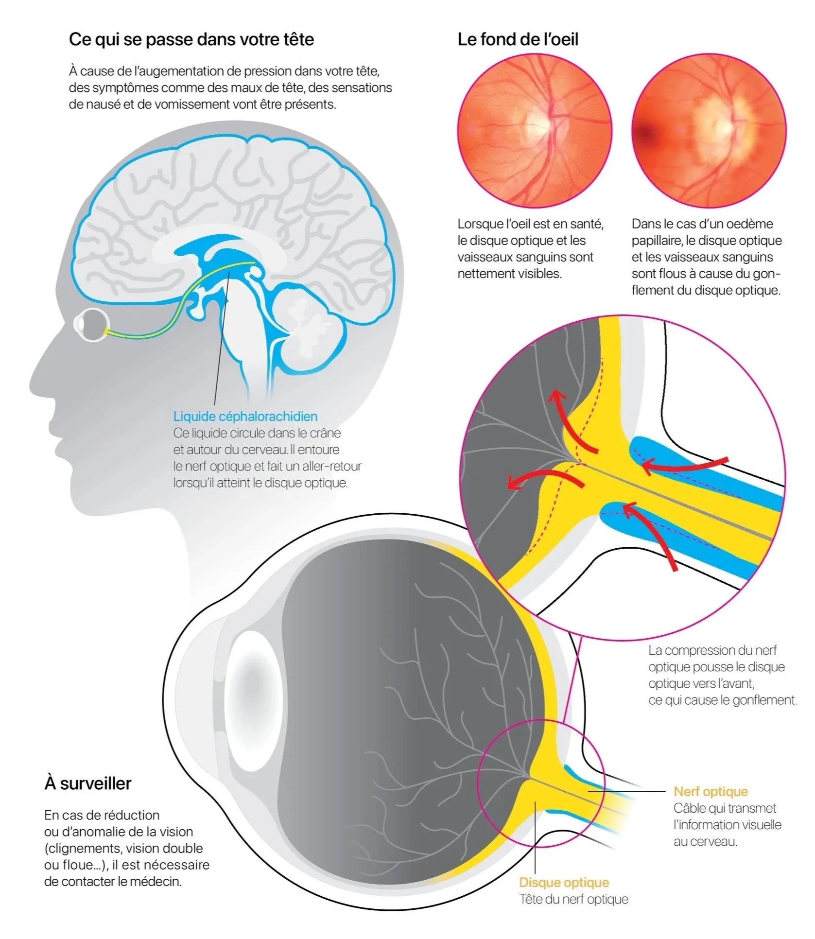 Brochure: œdème papillaire
